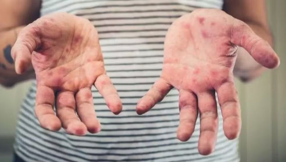 GRAVE - Agevisa investiga caso suspeito de sarampo em Rondônia