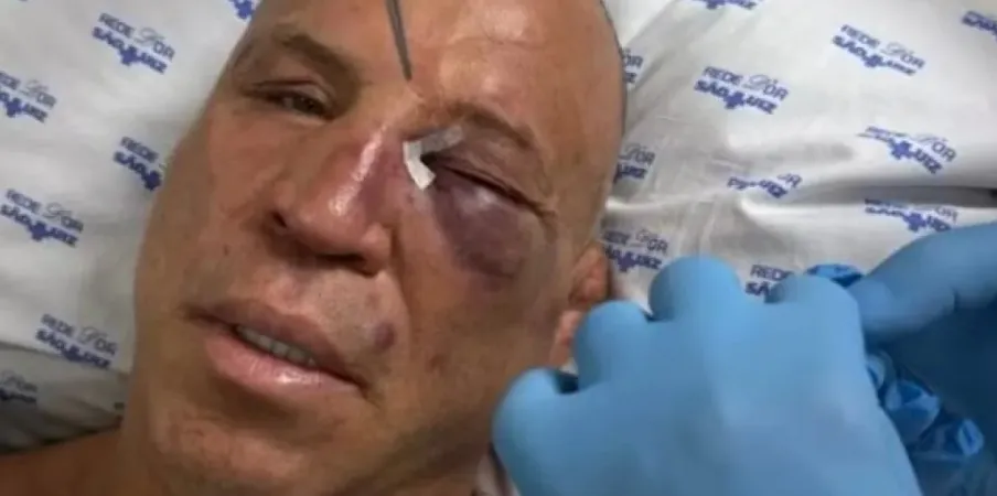 NOCAUTE: SEM REGRAS - Com olho roxo, Wanderlei recebe alta após nocaute em pancadaria

