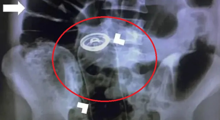 Homem é hospitalizado ao "perder" frasco de desodorante no reto, em Porto Velho