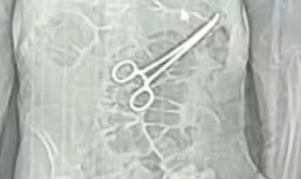 Idoso morre, e família denuncia que pinça foi esquecida no corpo