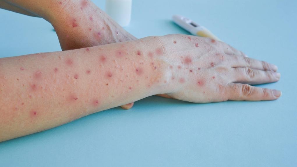 Foram notificados seis casos, mas só restam duas internações de Mpox em Porto Velho, Rondônia