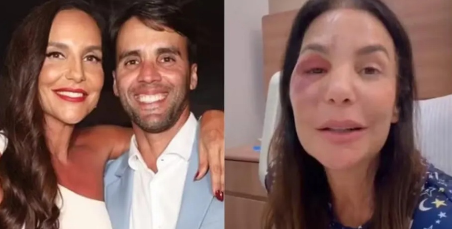 Ex-marido de Ivete fala sobre a cirurgia da cantora: 'Mulher de aço'
