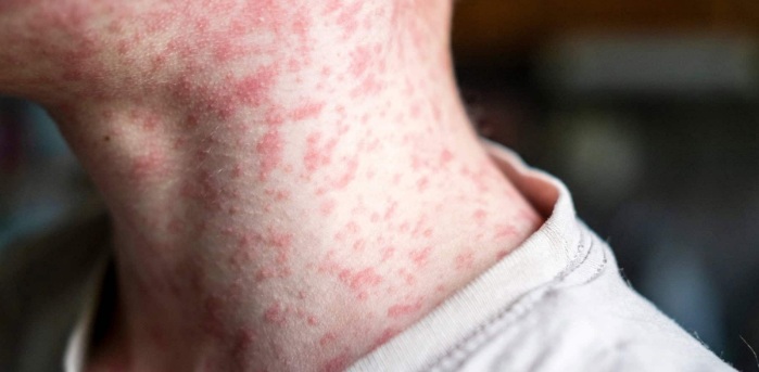 Brasil entra em alerta máximo por surtos de sarampo na América