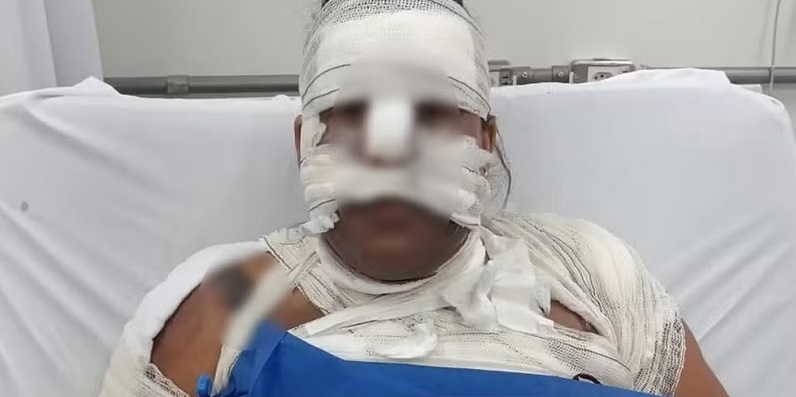 VINGANÇA DE CORNO - Homem tem 80% do corpo queimado em ataque com gasolina; ex-marido da esposa é preso
