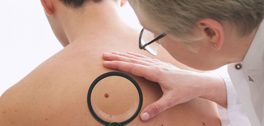 Câncer de pele: causas, sintomas e tratamentos