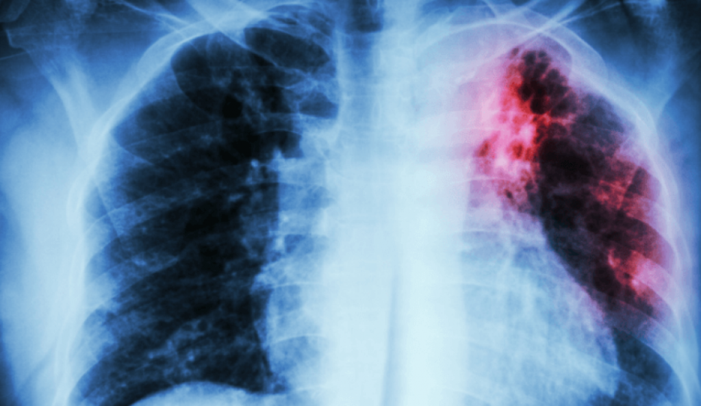 Tuberculose pulmonar atacou 520 em Rondônia; tratamento tem que ser completo