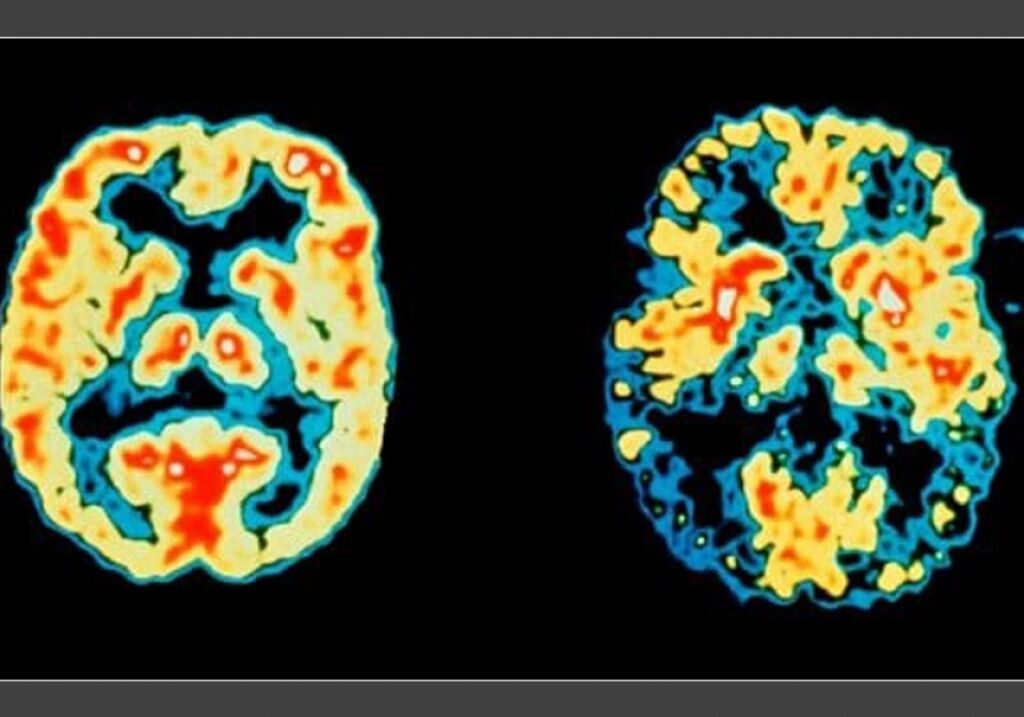 Gene que causa Alzheimer é neutralizado pela 1º vez em humanos