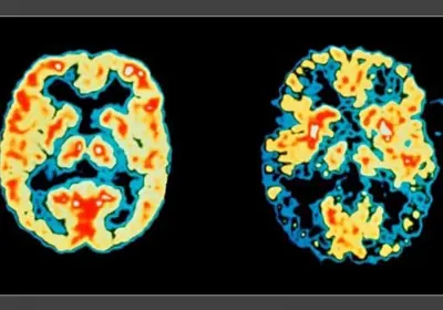 Gene que causa Alzheimer é neutralizado pela 1º vez em humanos