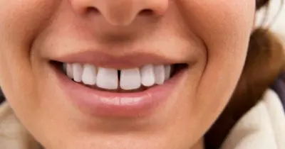 Diastema na moda: corrigir ou não corrigir o sorriso separado?