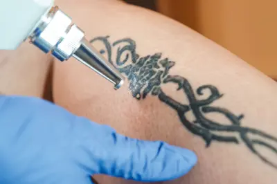Descoberta abre caminho para técnica de remoção de tatuagens