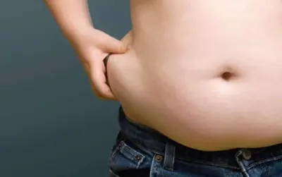 Obesidade pode estar relacionada a diversos problemas de circulação, como varizes e trombose