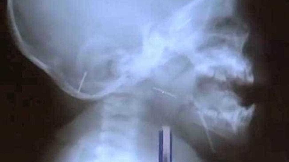 Bebê é perfurado com agulhas em ritual para 'afastar espíritos ruins'