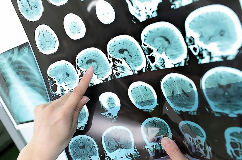 Saques do FGTS por Parkinson ou Alzheimer poderão ser autorizados