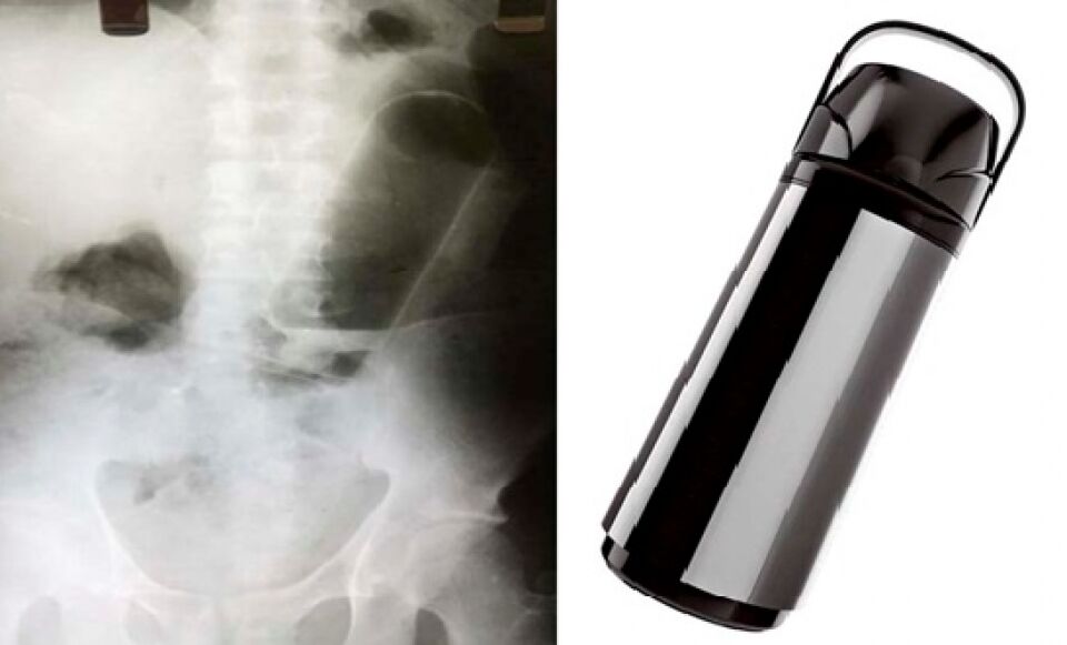 Com garrafa de café enfiada no rabo, namorado procura ajuda no hospital