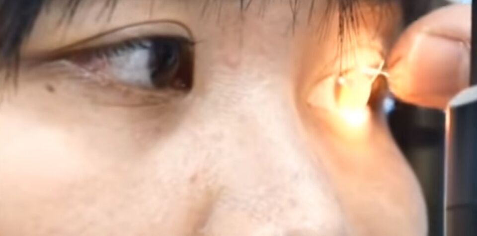 Médico encontra quatro abelhas vivas em olho de mulher em Taiwan