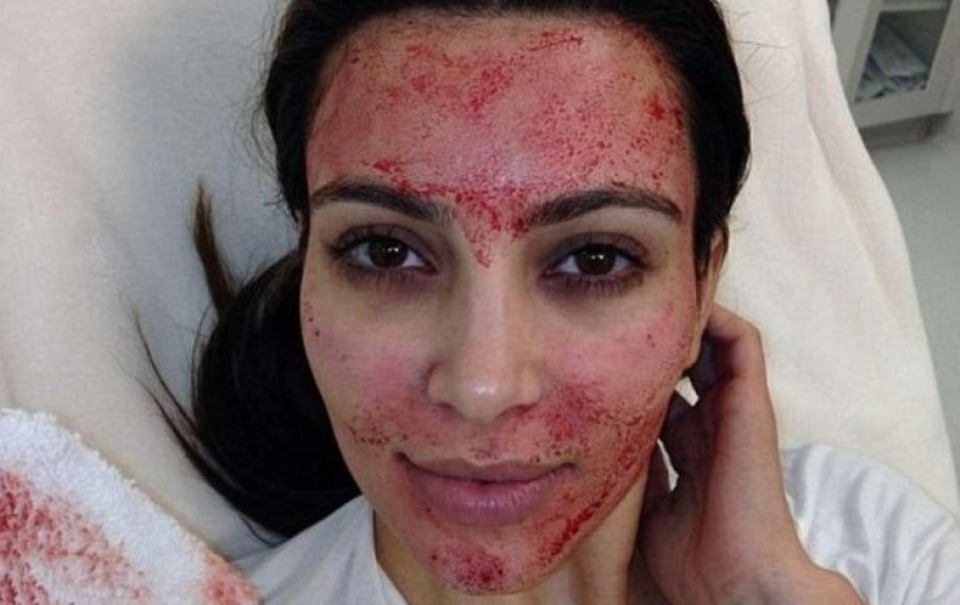 Dois clientes contraem HIV após tratamento facial com agulhas sujas em spa