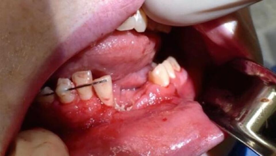 Adolescente de 17 anos perde vários dentes após cigarro eletrônico explodir