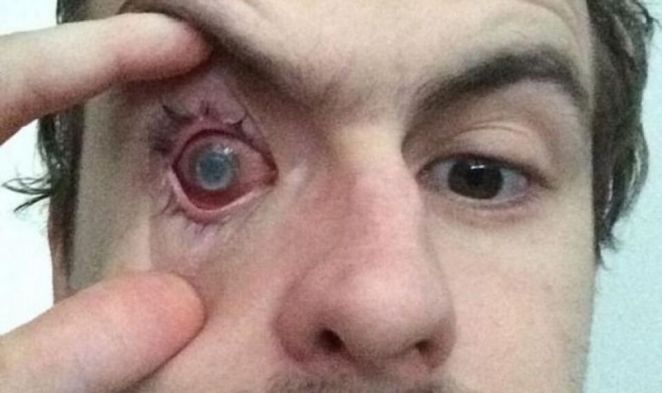 Jovem fica cego de um olho após tomar banho usando lente