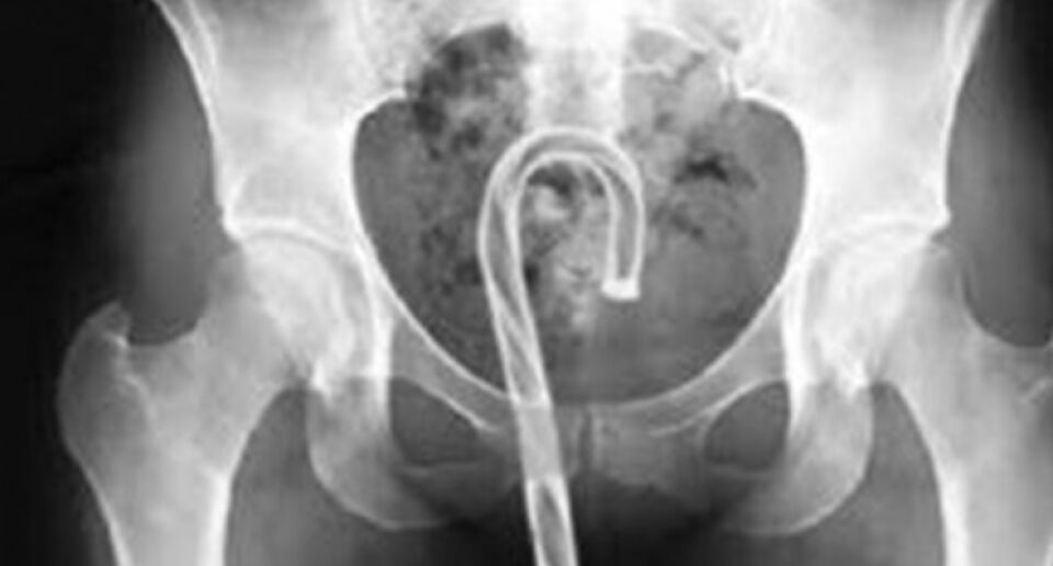 Menina dá entrada as pressas em hospital com a bengala de seu bisavô na vagina