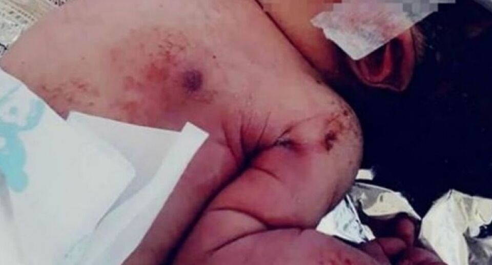 Recém-nascido com o braço quebrado é abandonado em construção