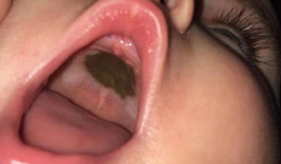 Mãe tem surpresa após levar filha com mancha escura no céu da boca ao hospital
