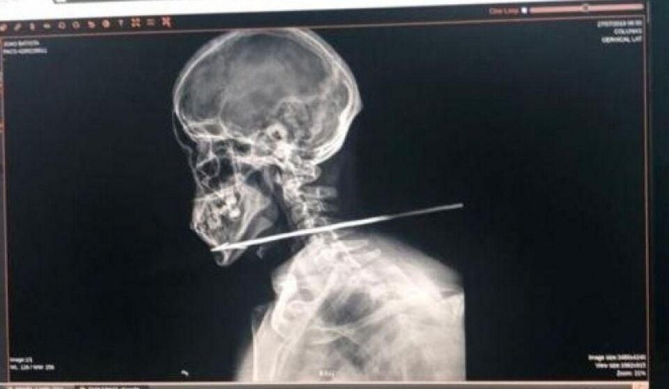 Brasileiro leva flechada no pescoço ao tentar cruzar fronteira