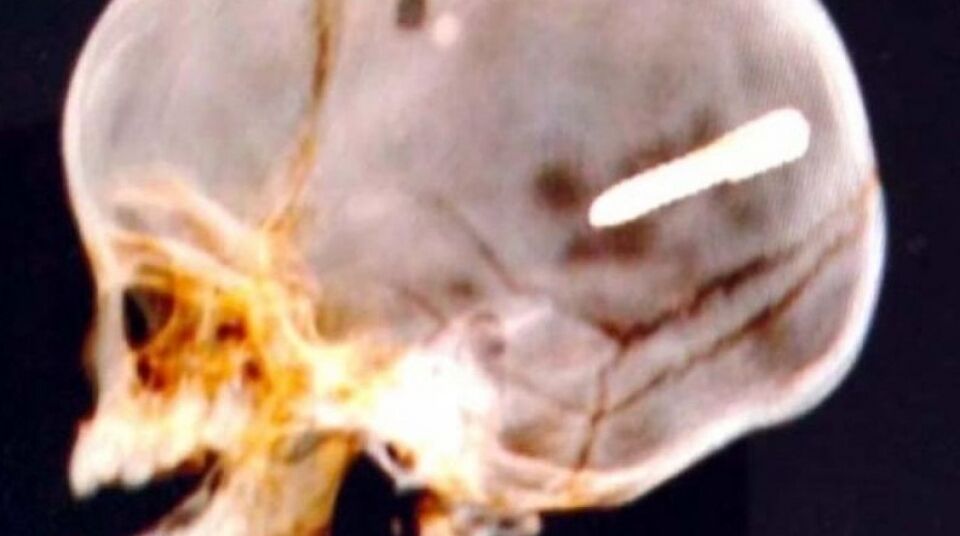 Bebê de 10 meses é atingido por prego que perfurou seu crânio e sobrevive