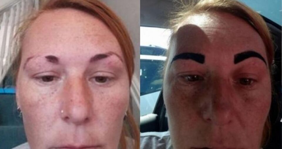 Mulher fica com sobrancelhas de desenho animado após erro em procedimento