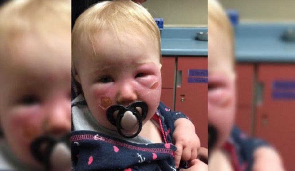 Mãe se desespera após bebê ficar queimado com produto infantil muito comum