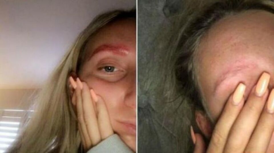 Jovem perde as sobrancelhas após tratamento estético