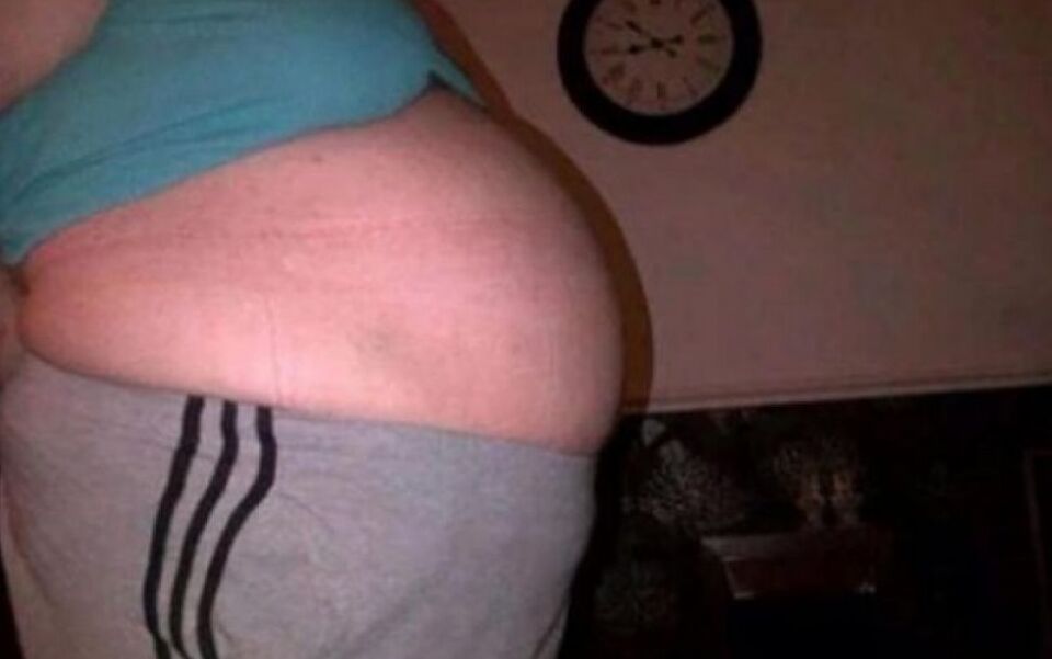 Mulher descobre que cisto em seu ovário era sua irmã malformada