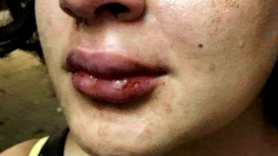 SURRADA: Jovem é espancada por chamar mulher de gorda em, RO