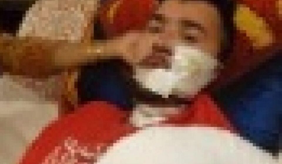 Celular explode e queima rosto e braço de homem