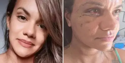 Agredida com 61 socos por ex-jogador mostra rosto dias após cirurgia